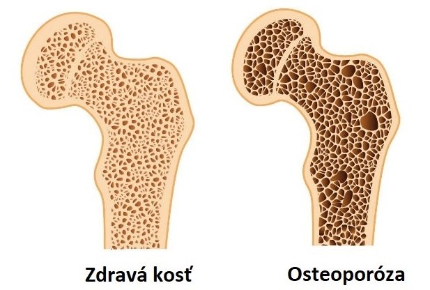 Porovnanie zdravej kosti a kosti postihnutej osteoporózou.
