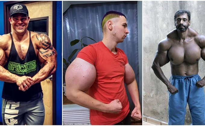 Hazard so zdravím: Synthol môže spôsobiť amputáciu končatín či smrť