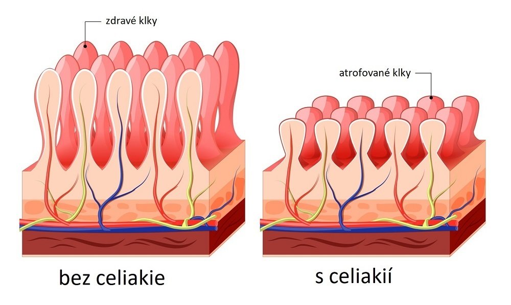 Celiakie.